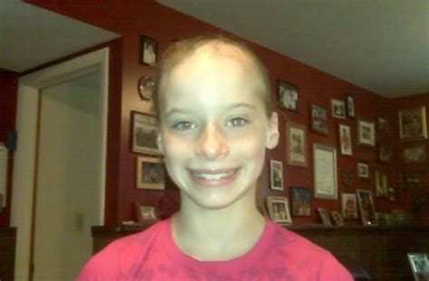 chloe bean bald|TikTok star Chloe Bean talks alopecia journey.